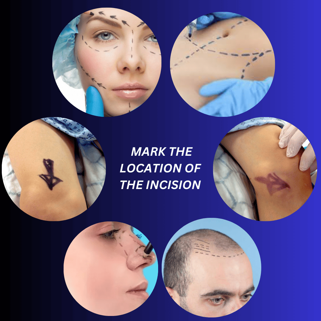 Surgical Skin Markers additional